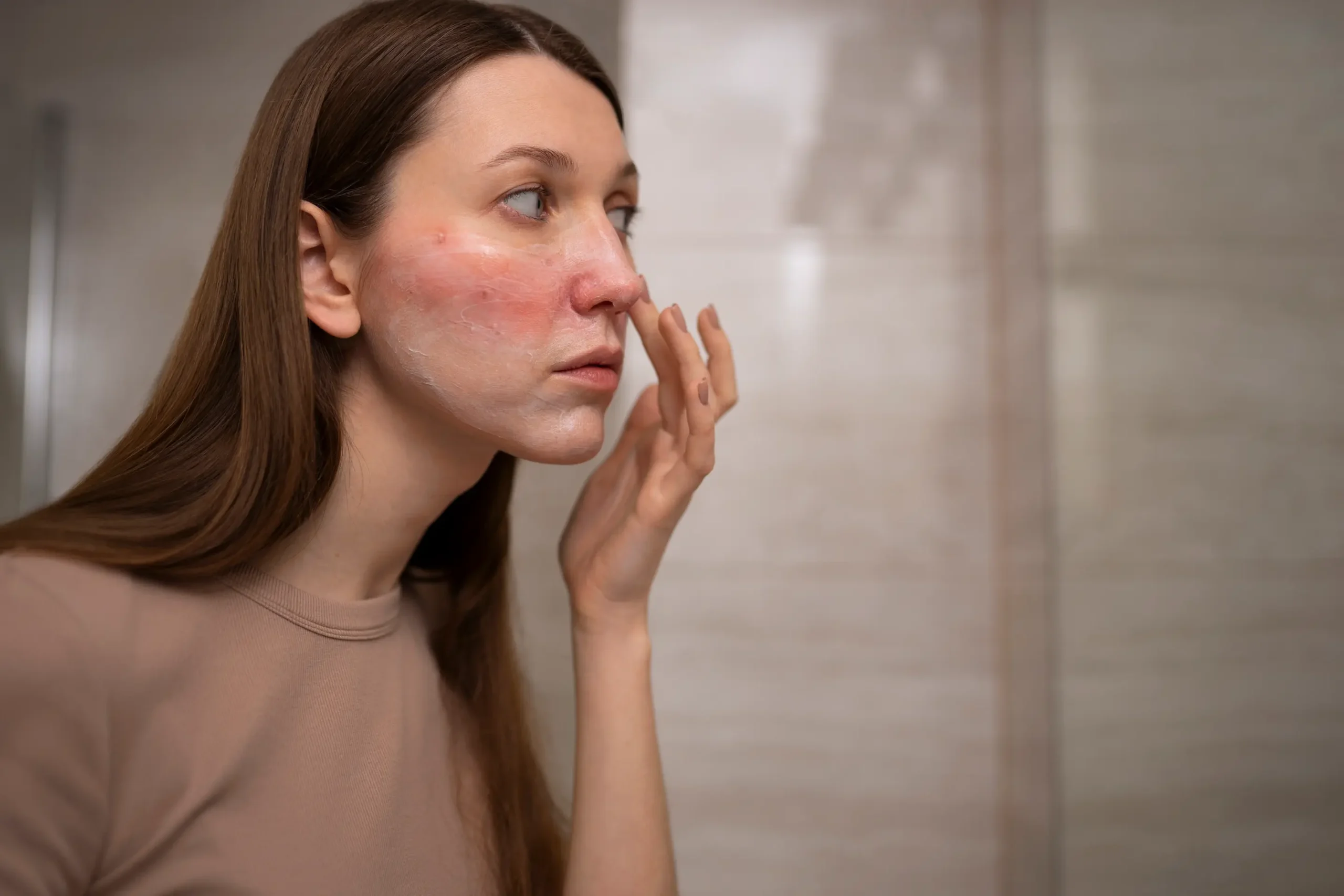 rosacea