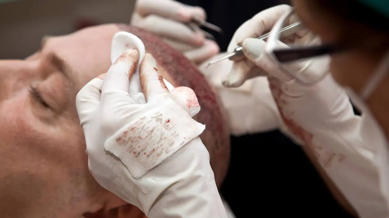 El trasplante capilar en Turquía ha tenido una gran repercusión en los últimos años, aunque no siempre con los resultados esperados